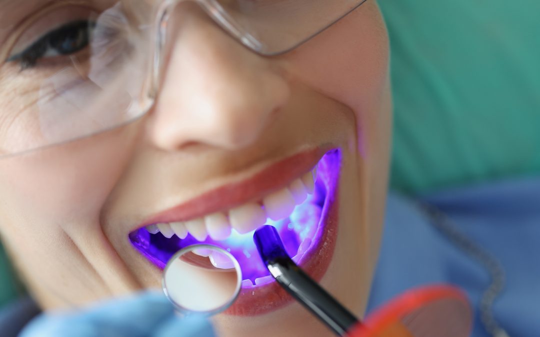 Dental Sealants